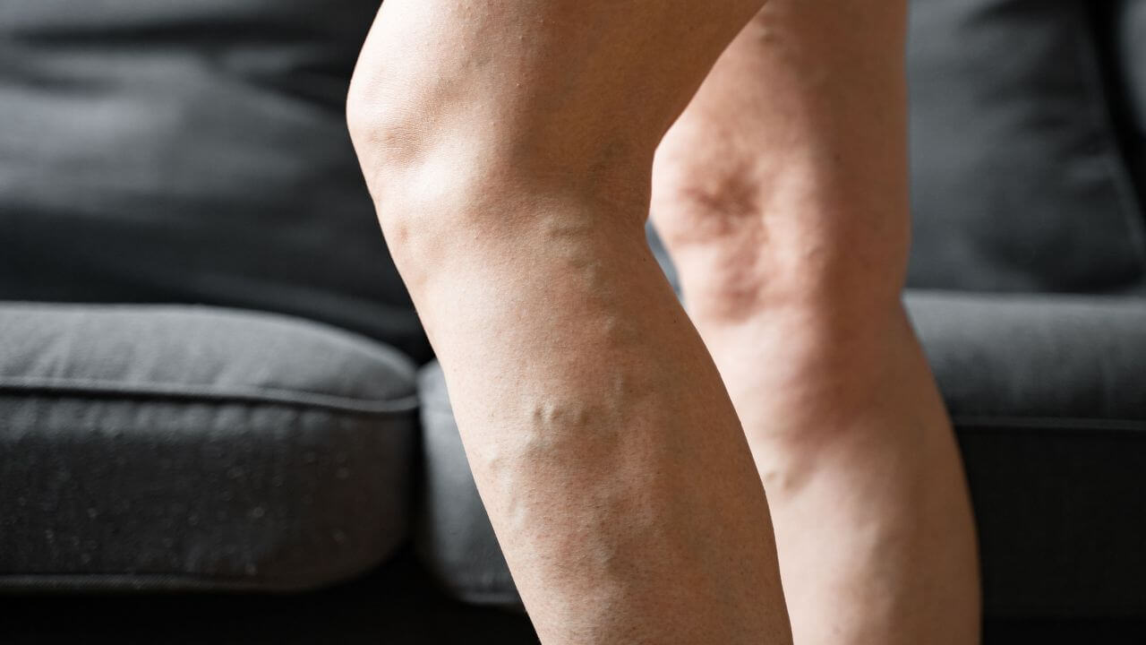 Treat Restless Legs Syndrome with 4 Effective Varicose Vein Treatments